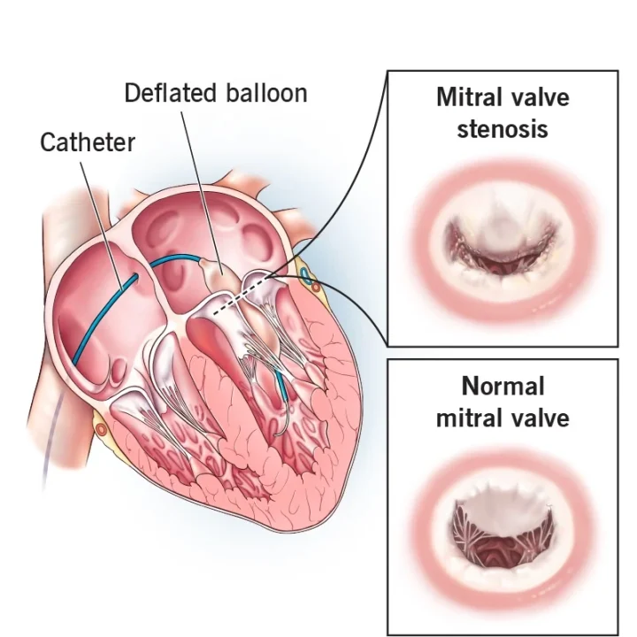 23277-valvuloplasty.webp 23277-valvuloplasty.webp