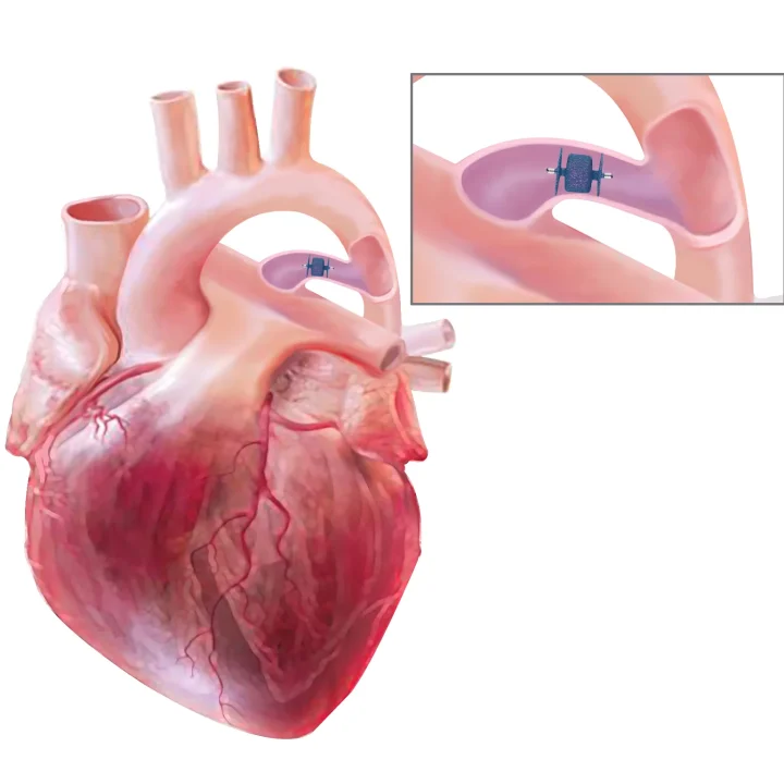non-surgical-pda-closure-pda-occluder-device.webp non-surgical-pda-closure-pda-occluder-device.webp